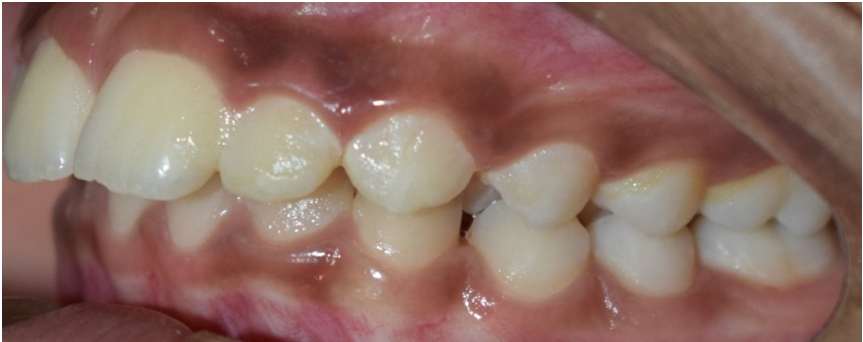 Class 2 Distalization - Before